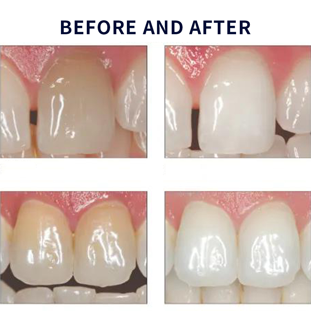 Opalescência Whitening Gel Kit - Teeth Whitening Kit At Home avaliação e preço