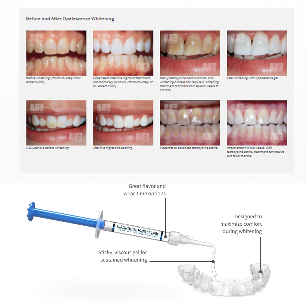 Opalescência Whitening Gel Kit - Teeth Whitening Kit At Home avaliação e preço