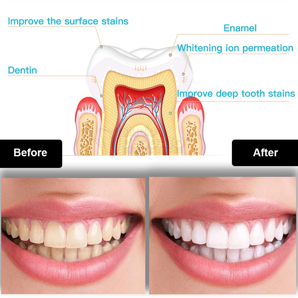 Kit de clareamento dental dos  - Teeth Whitening That Works avaliação e preço